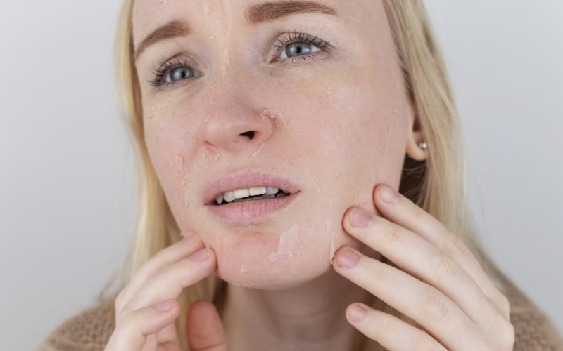 girl worried about Dry Skin on face