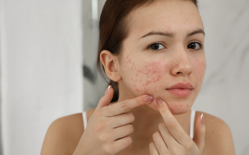 girl looking at pimples on face