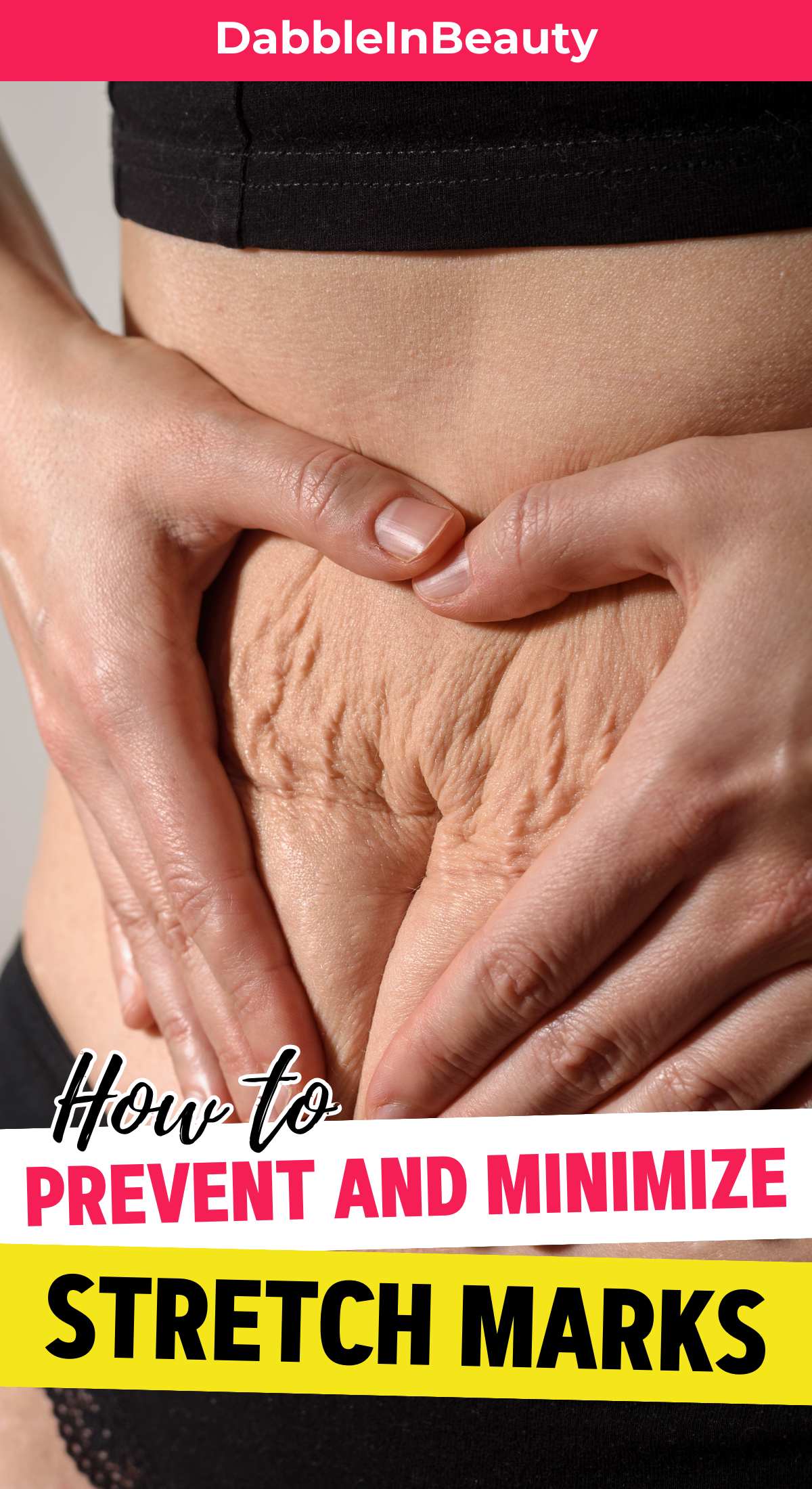 How to Prevent and Minimize Stretch Marks: A Blog about Stretch Marks that Discuss Causes, Prevention, and How to Minimize Them