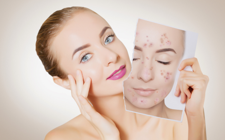 How To Remove Pimples Naturally And Permanently Dabble In Beauty