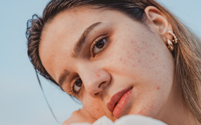 woman looking in camera with acne, red dots