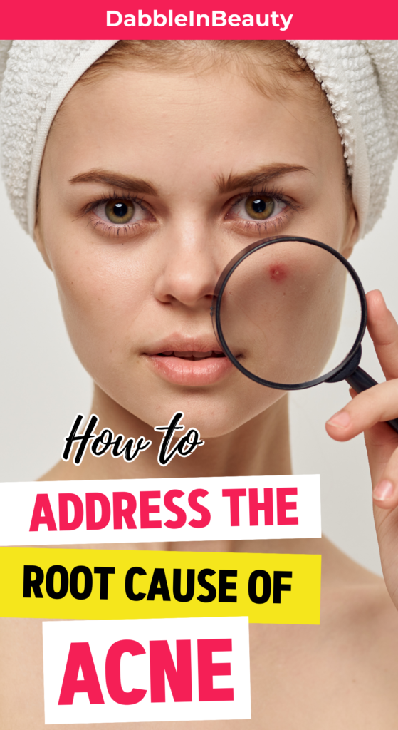 Address the root cause of acne