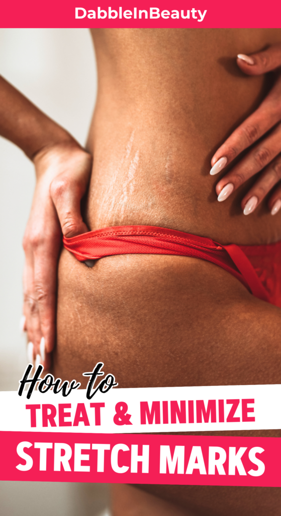 Treat & Minimize Stretch Marks